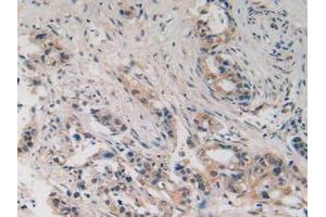 IHC-P analysis of Human Pancreas Cancer Tissue, with DAB staining. (SLIT2 anticorps  (AA 1416-1528))