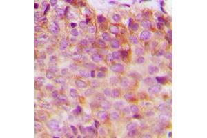 Immunohistochemical analysis of 14-3-3 eta staining in human breast cancer formalin fixed paraffin embedded tissue section.