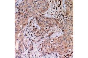 Immunohistochemical analysis of USP6NL staining in human breast cancer formalin fixed paraffin embedded tissue section. (USP6NL anticorps)