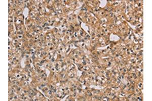 The image on the left is immunohistochemistry of paraffin-embedded Human prostate cancer tissue using ABIN7128941(CHRNA4 Antibody) at dilution 1/20, on the right is treated with fusion protein. (CHRNA4 anticorps)