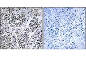 Immunohistochemistry analysis of paraffin-embedded human lung carcinoma tissue, using ATP5D Antibody. (ATP5F1D anticorps  (AA 61-110))