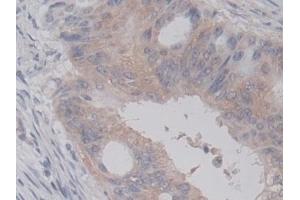 Detection of RALA in Human Colorectal cancer Tissue using Monoclonal Antibody to V-Ral Simian Leukemia Viral Oncogene Homolog A (RALA)