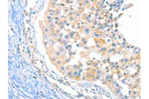 The image on the left is immunohistochemistry of paraffin-embedded Human breast cancer tissue using ABIN7129275(DUSP14 Antibody) at dilution 1/20, on the right is treated with fusion protein. (DUSP14 anticorps)