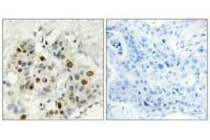 Immunohistochemistry analysis of paraffin-embedded human breast carcinoma tissue, using AF4 antibody. (AF4 anticorps  (N-Term))
