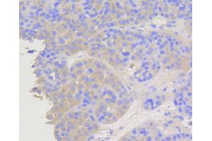 Immunohistochemistry of paraffin-embedded human liver cancer using ARRB1 antibody (ABIN5996907) at dilution of 1/100 (40x lens). (beta Arrestin 1 anticorps)