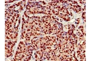Immunohistochemistry of paraffin-embedded human ovarian cancer using ABIN7164525 at dilution of 1:100 (EARS2 anticorps  (AA 42-166))