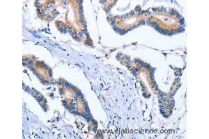 Immunohistochemistry of Human colon cancer using PLK3 Polyclonal Antibody at dilution of 1:30 (PLK3 anticorps)