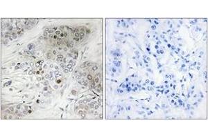 Immunohistochemistry analysis of paraffin-embedded human breast carcinoma, using p53 (Phospho-Ser9) Antibody. (p53 anticorps  (pSer9))