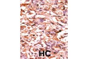 Formalin-fixed and paraffin-embedded human hepatocellular carcinoma tissue reacted with CDC25B (phospho S187) polyclonal antibody  which was peroxidase-conjugated to the secondary antibody followed by AEC staining.