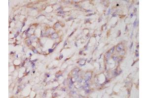 Formalin-fixed and paraffin embedded human lung carcinoma labeled with Anti-SAPK3 (Thr183+Tyr185) Polyclonal Antibody, Unconjugated  at 1:200 followed by conjugation to the secondary antibody and DAB staining (MAPK12 anticorps  (pThr183, pTyr185))