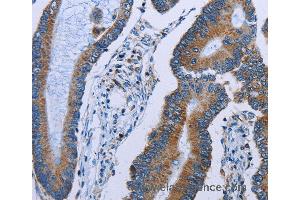 Immunohistochemistry of Human colon cancer using IDH2 Polyclonal Antibody at dilution of 1:60 (IDH2 anticorps)