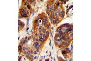 Immunohistochemistry analysis in formalin fixed and paraffin embedded human bladder carcinoma reacted with LRRC57 Antibody (C-term) followed which was peroxidase conjugated to the secondary antibody and followed by DAB staining. (LRRC57 anticorps  (C-Term))