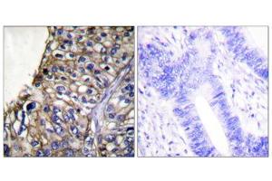 Immunohistochemical analysis of paraffin-embedded human lung carcinoma tissue using Claudin 7 antibody (ABIN5976363). (Claudin 7 anticorps  (C-Term))