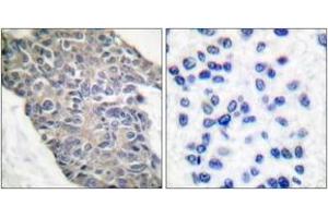 Immunohistochemistry analysis of paraffin-embedded human breast carcinoma tissue, using Synaptotagmin (Ab-202) Antibody. (Synaptotagmin anticorps  (AA 176-225))