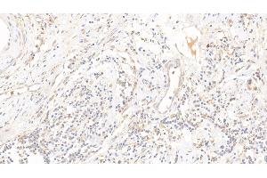 Detection of DPP3 in Human Endometrial cancer Tissue using Polyclonal Antibody to Dipeptidyl Peptidase 3 (DPP3)