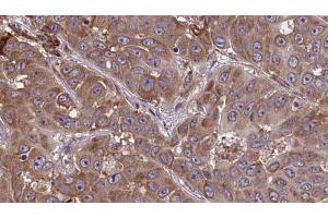 ABIN6273449 at 1/100 staining Human liver cancer tissue by IHC-P.