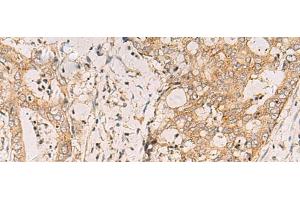 Immunohistochemistry of paraffin-embedded Human cervical cancer tissue using FYCO1 Polyclonal Antibody at dilution of 1:110(x200) (FYCO1 anticorps)
