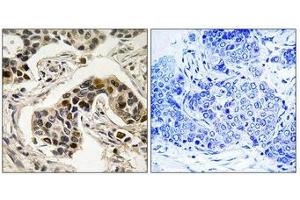 Immunohistochemistry analysis of paraffin-embedded human breast carcinoma tissue using NudC (Phospho-Ser326) antibody. (NUDC anticorps  (pSer326))