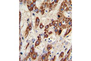 Formalin-fixed and paraffin-embedded human hepatocarcinoma reacted with MMP3 Antibody , which was peroxidase-conjugated to the secondary antibody, followed by DAB staining. (MMP3 anticorps  (AA 298-327))