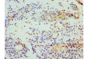 Immunohistochemistry of paraffin-embedded human breast cancer using ABIN7152008 at dilution of 1:100 (Stomatin anticorps  (AA 55-288))
