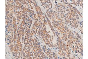ABIN6267067 at 1/100 staining rat tumor tissue sections by IHC-P.