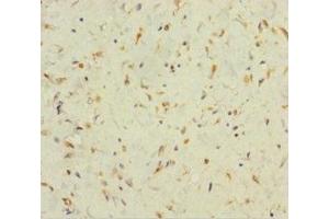 Immunohistochemistry of paraffin-embedded human colon cancer using ABIN7165526 at dilution of 1:100 (Protein FAM60A (SINHCAF) (AA 1-221) anticorps)