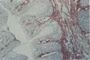 Carcinoma in situ, vulva (MAb EB2, tenascin) (TNC anticorps)