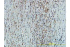 Immunoperoxidase of monoclonal antibody to TYK2 on formalin-fixed paraffin-embedded human lymphoma.