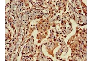 Immunohistochemistry of paraffin-embedded human lung cancer using ABIN7161610 at dilution of 1:100 (NINJ1 anticorps  (AA 1-80))
