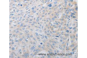 Immunohistochemistry of Human esophagus cancer using PDX1 Polyclonal Antibody at dilution of 1:30 (PDX1 anticorps)