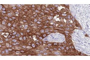 ABIN6277050 at 1/100 staining Human Head and neck cancer tissue by IHC-P.