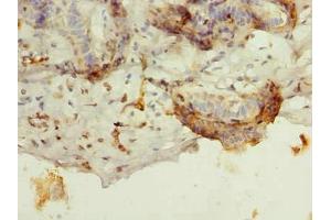 Immunohistochemistry of paraffin-embedded human breast cancer using ABIN7145275 at dilution of 1:100
