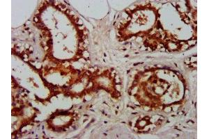 IHC image of ABIN7172586 diluted at 1:600 and staining in paraffin-embedded human breast cancer performed on a Leica BondTM system.