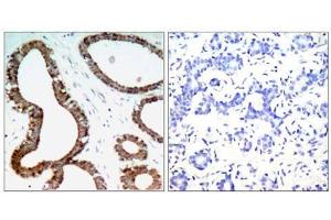 Immunohistochemical analysis of paraffin-embedded human breast carcinoma tissue, using 14-3-3 ζ (Ab-58) antibody (E021188). (14-3-3 zeta anticorps)