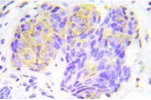 Immunohistochemistry (IHC) analyzes of p-4E-BP1 antibody in paraffin-embedded human lung adenocarcinoma tissue. (eIF4EBP1 anticorps  (pThr45))