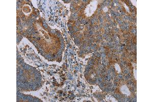 Immunohistochemistry of Human thyroid cancer using CYP7A1 Polyclonal Antibody at dilution of 1:20