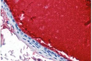 Human Breast, Ductal with Secretion (formalin-fixed, paraffin-embedded) stained with LTF antibody ABIN337355 at 10 ug/ml followed by biotinylated anti-mouse IgG secondary antibody ABIN481714, alkaline phosphatase-streptavidin and chromogen. (Lactoferrin anticorps)