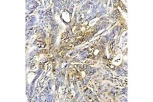 Immunohistochemistry analysis of human colon cancer tissue using HSP70 mAb (C92F3A-5) at a dilution of 1:50. (HSP70 anticorps)