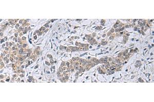 Immunohistochemistry of paraffin-embedded Human colorectal cancer tissue using SLC4A3 Polyclonal Antibody at dilution of 1:35(x200) (SLC4A3 anticorps)