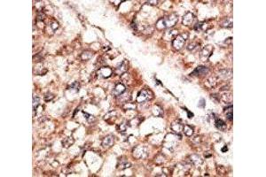 IHC analysis of FFPE human hepatocarcinoma tissue stained with the BMP3 antibody (BMP3 anticorps  (AA 8-36))