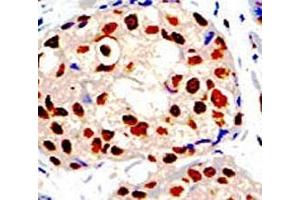 IHC analysis of FFPE human breast carcinoma tissue stained with the PRMT1 antibody (PRMT1 anticorps  (AA 316-347))