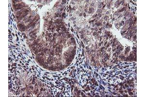 Immunohistochemical staining of paraffin-embedded Adenocarcinoma of Human endometrium tissue using anti-SETD7 mouse monoclonal antibody. (SETD7 anticorps)