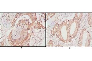 Immunohistochemical analysis of paraffin-embedded human lung cancer (A) and rectal cancer (B), showing cytoplasmic localization using DDX4 mouse mAb with DAB staining.