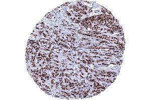 Invasive breast cancer of no special type NST with strong PR immunostaining in 100 of tumor cells