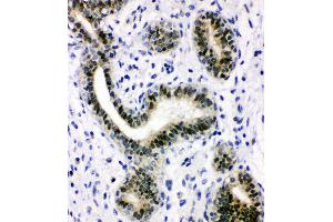Anti-XRCC1 antibody, IHC(P) IHC(P): Human Mammary Cancer Tissue