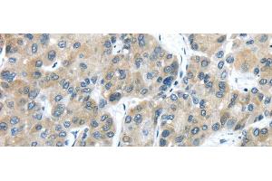 Immunohistochemistry of paraffin-embedded Human liver cancer using TXNDC5 Polyclonal Antibody at dilution of 1/40 (TXNDC5 anticorps)