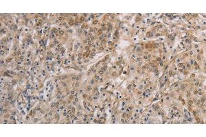 Immunohistochemistry of paraffin-embedded Human gastic cancer using ESRRG Polyclonal Antibody at dilution of 1:30 (ESRRG anticorps)