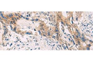 Immunohistochemistry of paraffin-embedded Human cervical cancer tissue using PCYT2 Polyclonal Antibody at dilution of 1:55(x200) (PCYT2 anticorps)