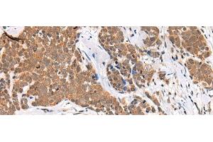 Immunohistochemistry of paraffin-embedded Human thyroid cancer tissue using CHAMP1 Polyclonal Antibody at dilution of 1:40(x200) (ZNF828 anticorps)