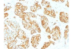 Formalin-fixed, paraffin-embedded human Prostate Carcinoma stained with CD44 Mouse Monoclonal Antibody (CD44v9/1459). (CD44 anticorps)